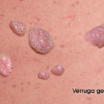 verruga-genital-002